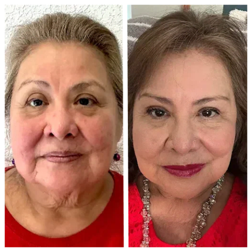 Before and After Treatment Image A