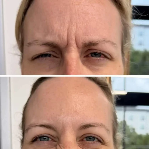 Before and After Treatment Image A