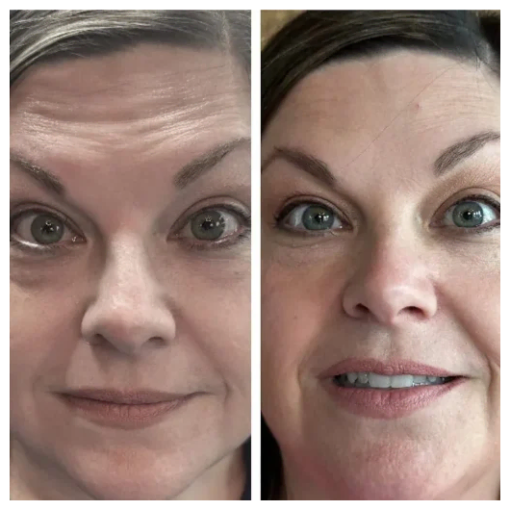 Before and After Treatment Image B