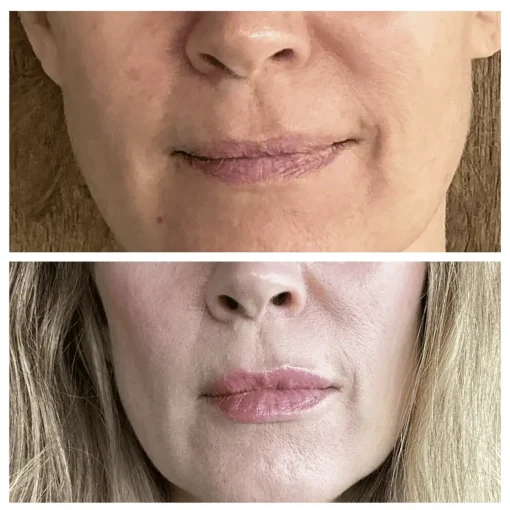 Before and After Treatment Image B