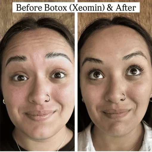 Before and After Treatment Image C