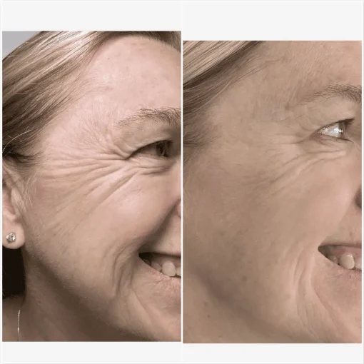 Before and After Treatment Image D