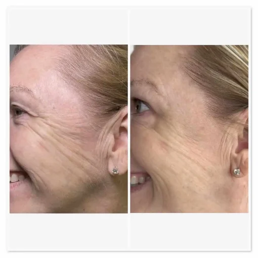 Before and After Treatment Image E