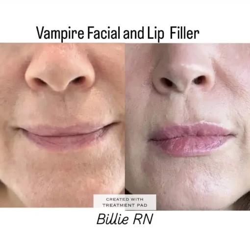 Before and After Treatment Image F