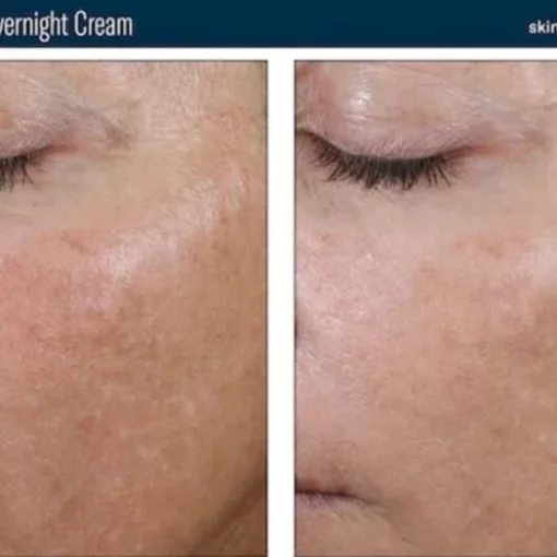 Before and After Treatment a