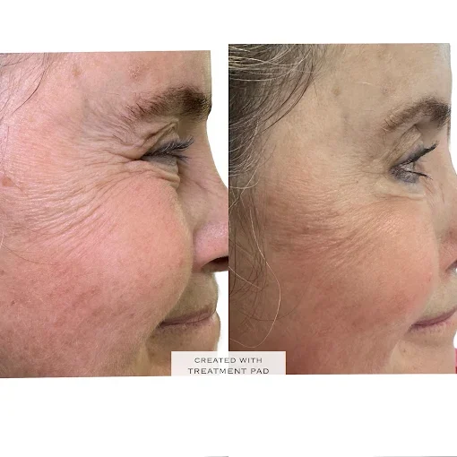 Before and After Treatment d