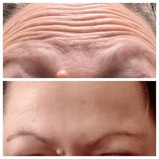 Before and After Treatment f