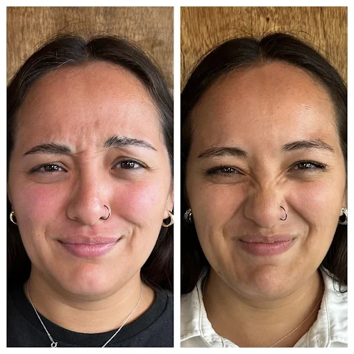 Before and After Treatment h