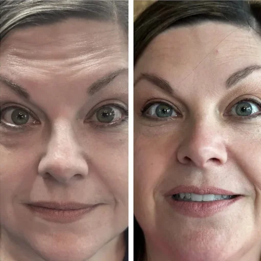 Before and After Treatment i