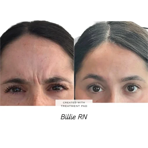 Before and After Treatment j