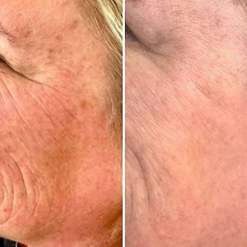 Before and After Treatment